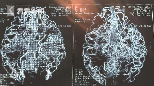 “生為幼兒教師,死為人體老師” 蘇州一教師患“煙霧病”去世后捐獻器官_社會圖文_看看新聞