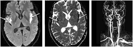 肺與腦的那些事--那些肺部病變相關(guān)的神經(jīng)科疾病