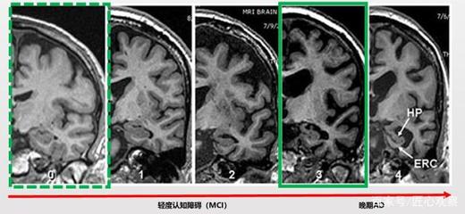 腦醫生AI影像平臺再發力 精準診斷技術助力神經內科發展
