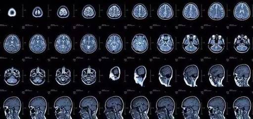 神經(jīng)內(nèi)科常見疾病 CT與磁共振的選擇指南